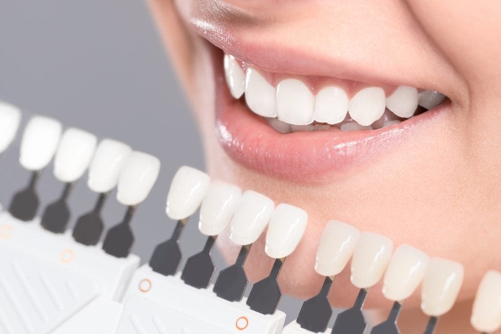 Descubre los diferentes tipos de carillas dentales que existen en el mercado.