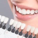 ¿Existen diferentes tipos de carillas dentales?
