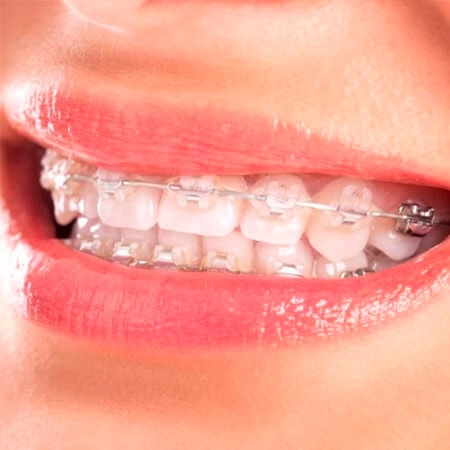 ortodoncia estetica de zafiro