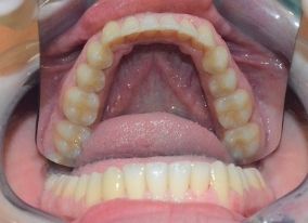 imagen de Caso real ortodoncia invisible inferior despues
