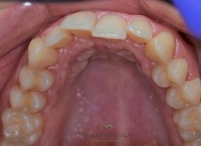 imagen de Caso real ortodoncia invisible superior antes