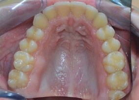 imagen de Caso real ortodoncia invisible superior despues