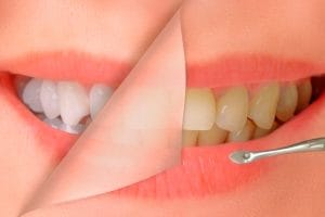 Blanqueamiento dental en Linares