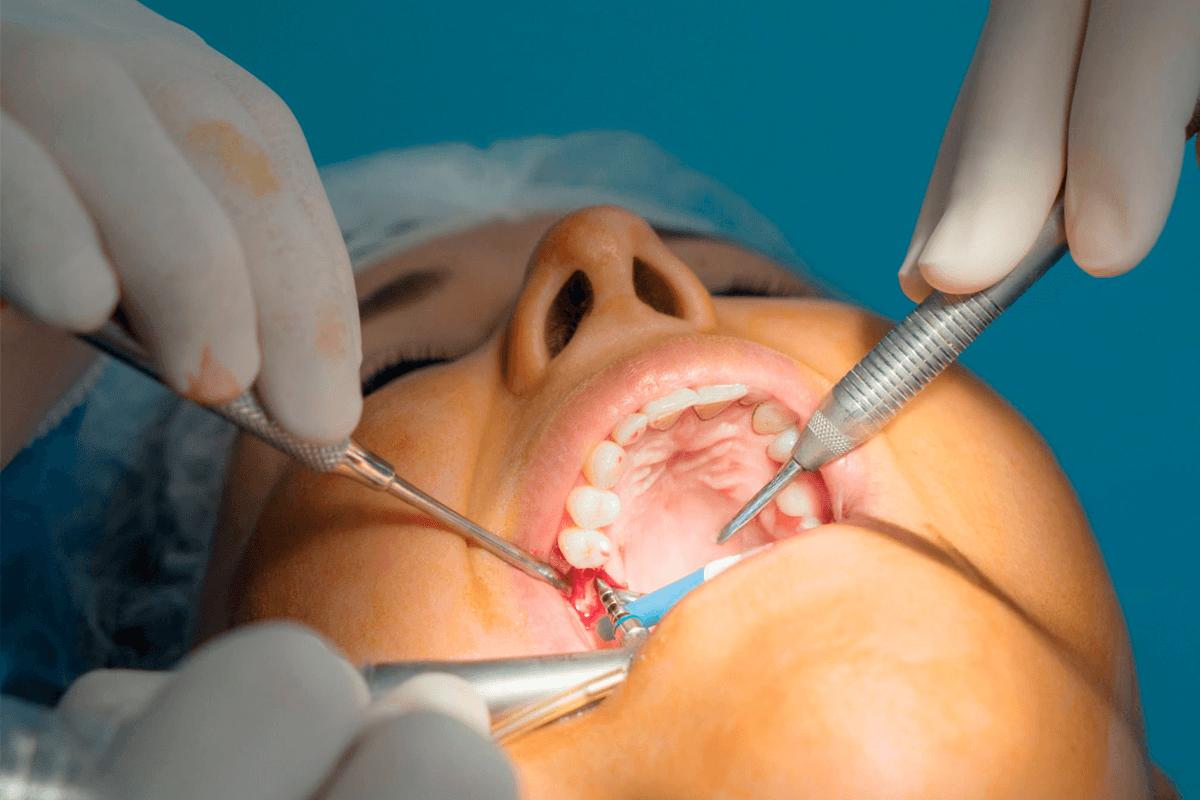 cuando se hace una endodoncia