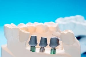 IMPLANTES DENTALES EN LINARES