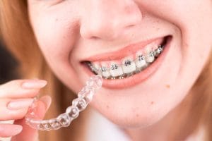 Ortodoncia en Linares