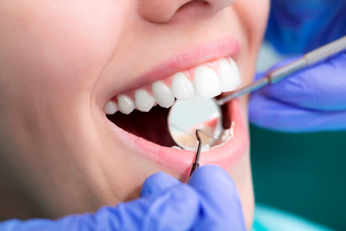 Prevención de la Periodontitis