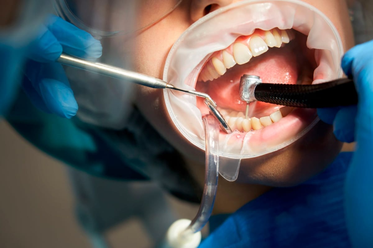 Cómo Prevenir la Periodontitis