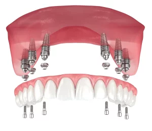 implantes All-on-6