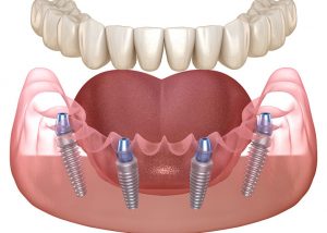 Implantes dentales all on 4