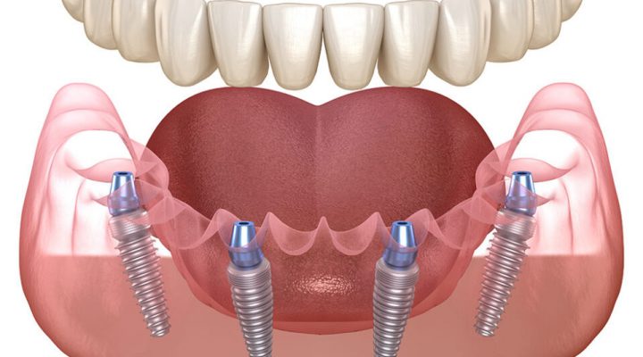 Implantes dentales all on 4