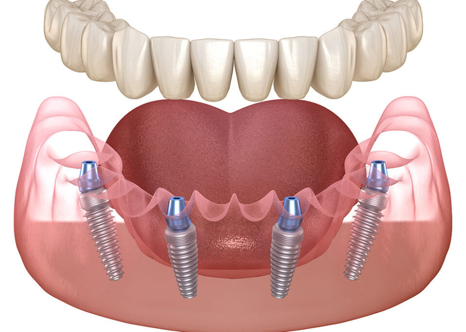 Implantes dentales all on 4