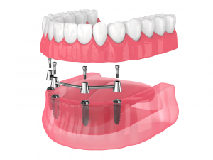 Implantes dentales all on 4