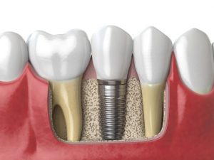 implante dental de titanio