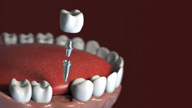 Implantes dentales de titanio