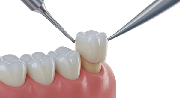 Implantes Dentales de Zirconio