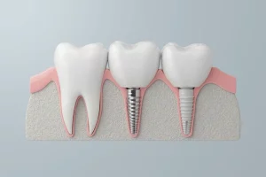 implantes de ceramica
