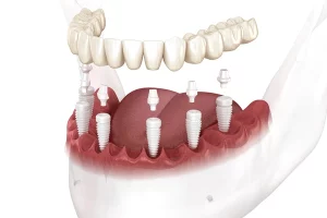 implantes dentales de cerámica