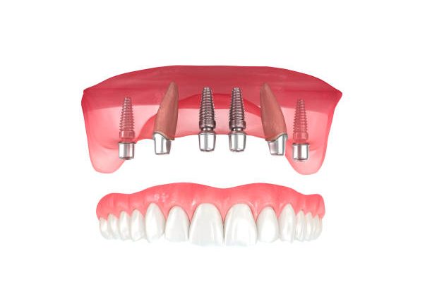protesis sobre implantes