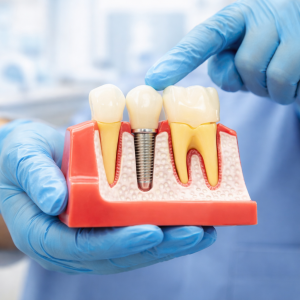 implantes dentales linares