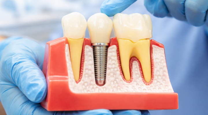 implantes dentales linares