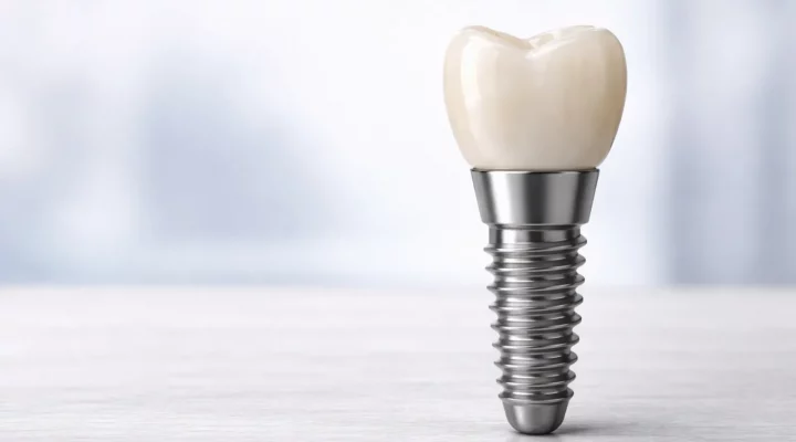 implantes dentales en linares