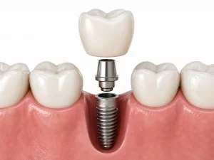 mantenimiento de implantes dentales
