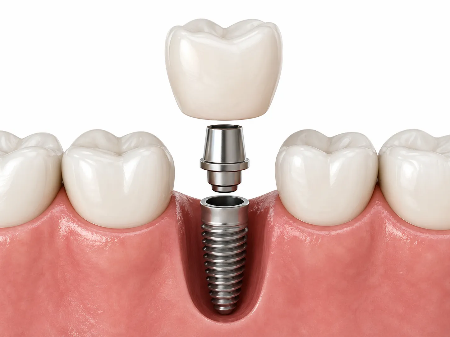 mantenimiento de implantes dentales